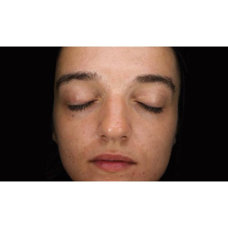 Mesoestetic Blemiderm Metodo Professionale Trattamento Acne