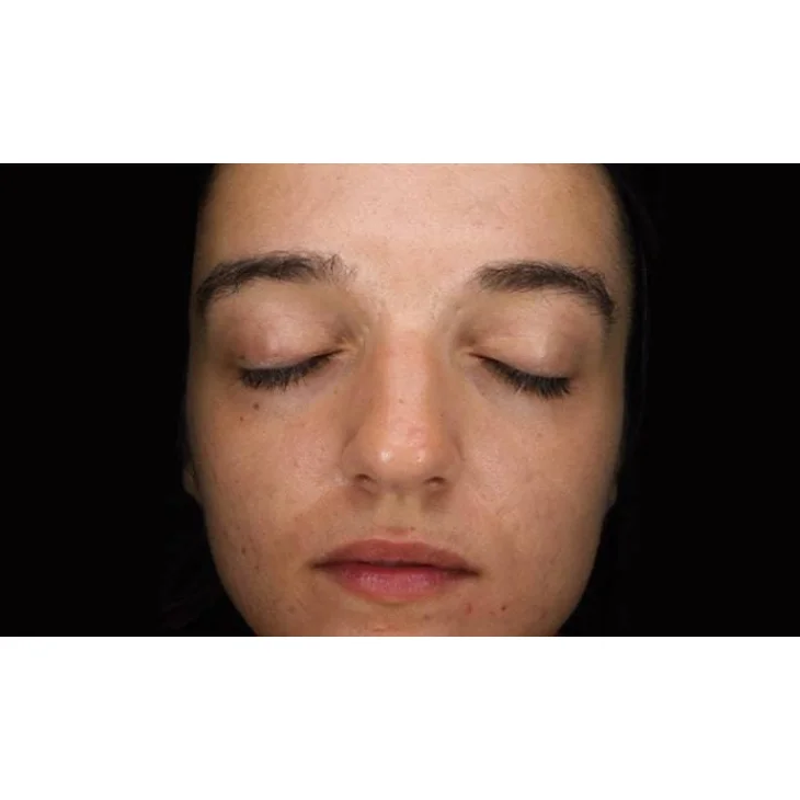 Mesoestetic Blemiderm Metodo Professionale Trattamento Acne