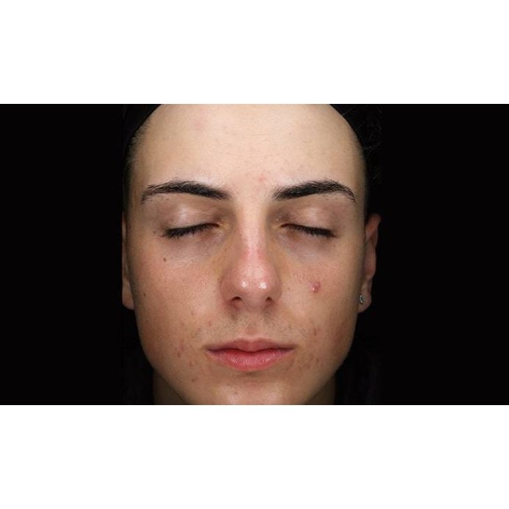 Mesoestetic Blemiderm Metodo Professionale Trattamento Acne
