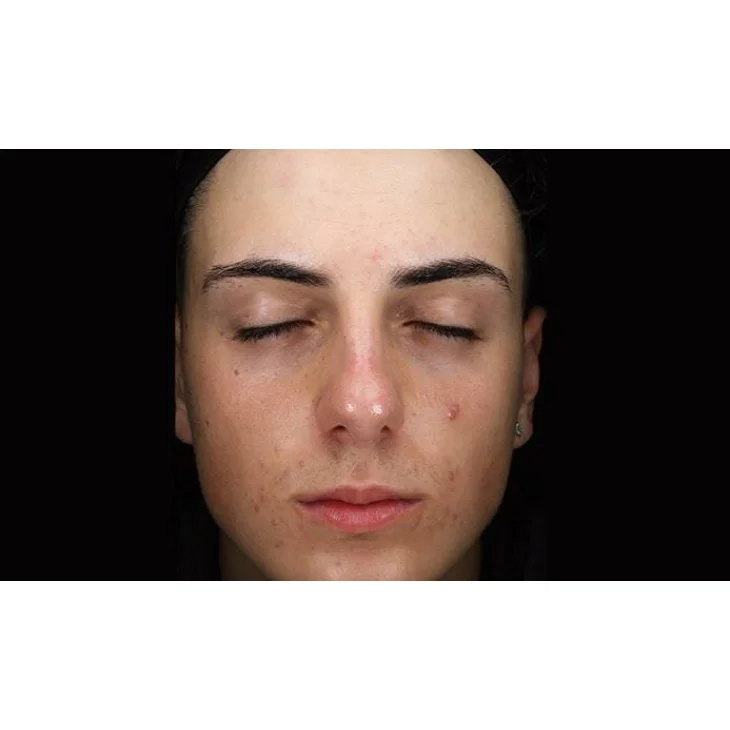 Mesoestetic Blemiderm Metodo Professionale Trattamento Acne