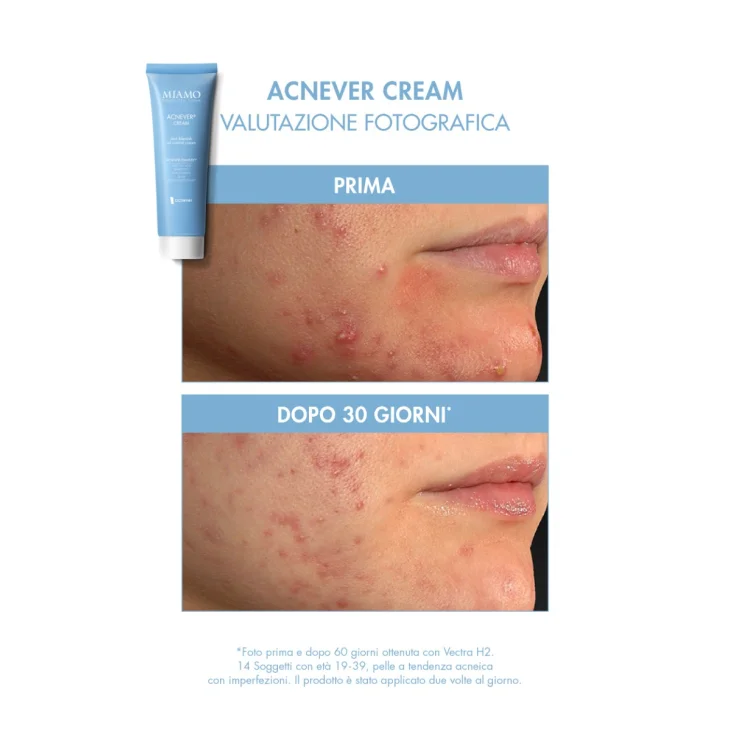 Miamo Protocollo Pelle Acneica Crema Acnever 50 ml + Skin Detox 60 capsule OMAGGIO