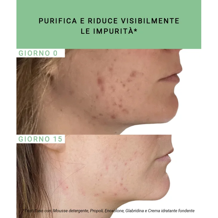 Etat Pur Propoli 750ppm Attivo Puro Anti-Acne 15 ml