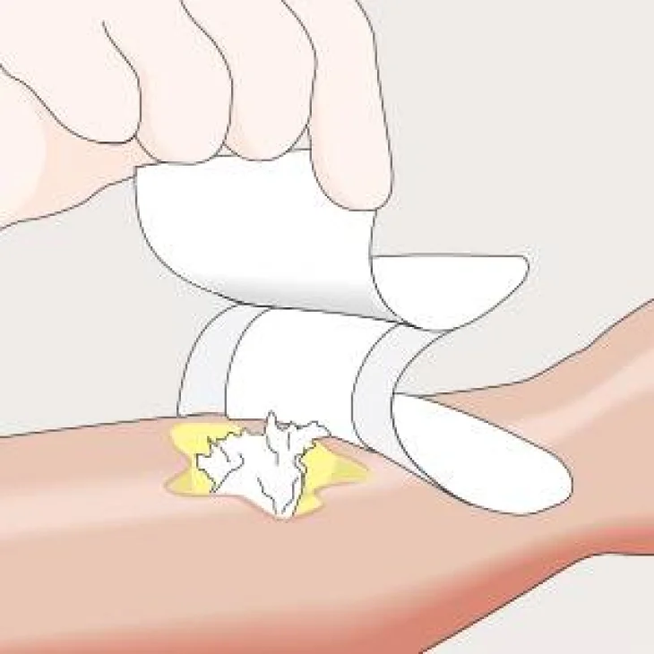 Mesalt Medicazione in Cloruro di Sodio per Ferite Essudanti 5X5 Cm 30 Pezzi