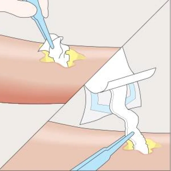 Mesalt Medicazione in Cloruro di Sodio per Ferite Essudanti 5X5 Cm 30 Pezzi