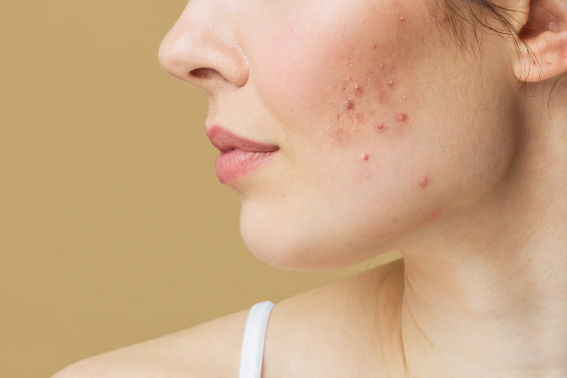 Come eliminare brufoli e punti neri: i nostri consigli per una skincare anti-imperfezioni