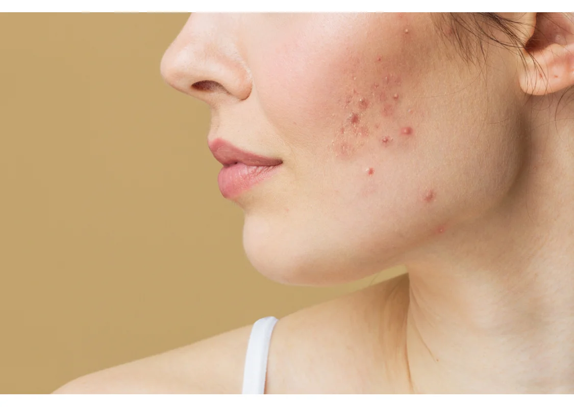 Come eliminare brufoli e punti neri: i nostri consigli per una skincare anti-imperfezioni Come eliminare brufoli e punti neri: i nostri consigli per una skincare anti-imperfezioni