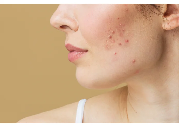 Come eliminare brufoli e punti neri: i nostri consigli per una skincare anti-imperfezioni