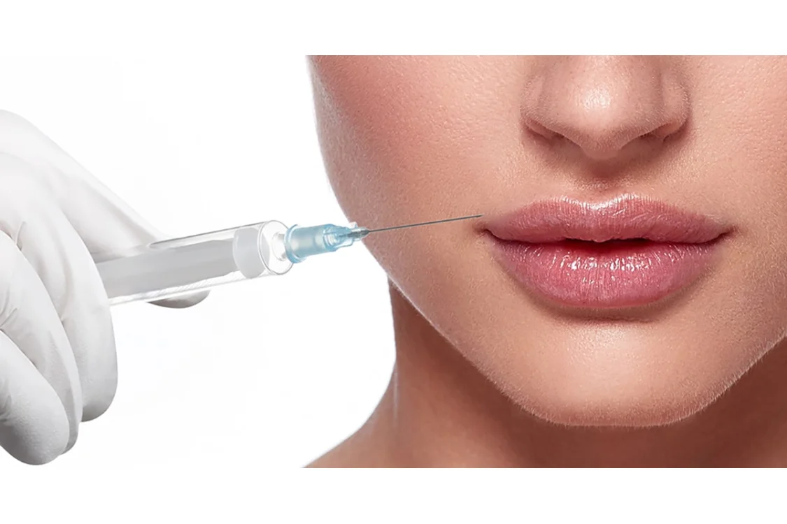 Rivitalizzare il viso con i filler