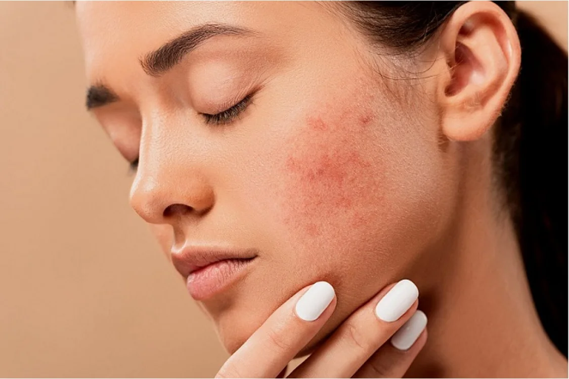Guida all'acne
