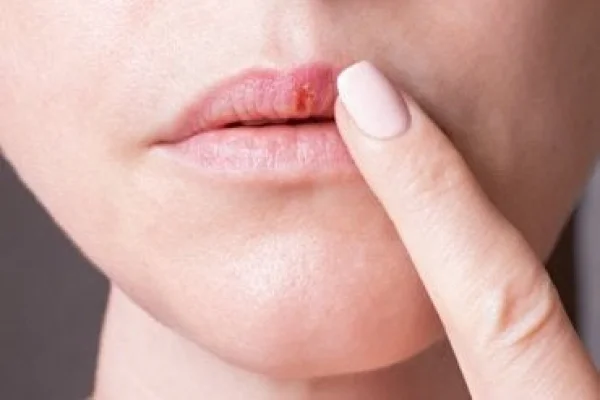 Tutto sull'herpes labialis