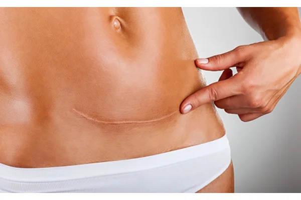 Guida al trattamento delle cicatrici