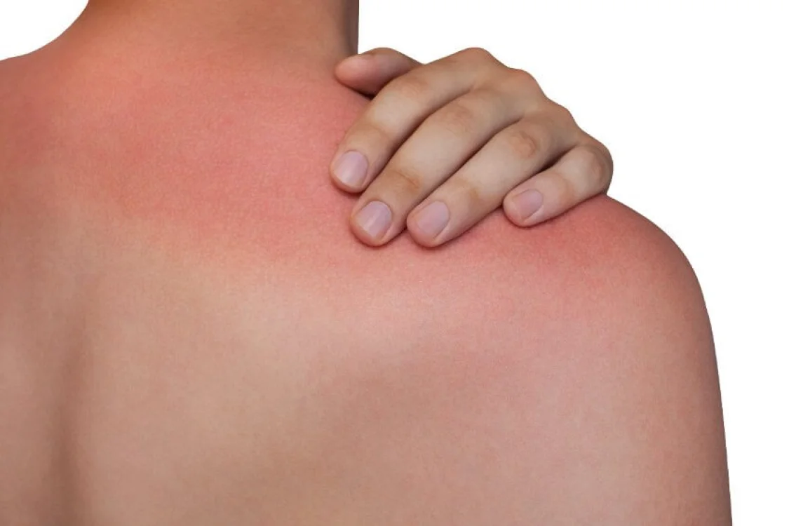 Tutto sull'eritema solare