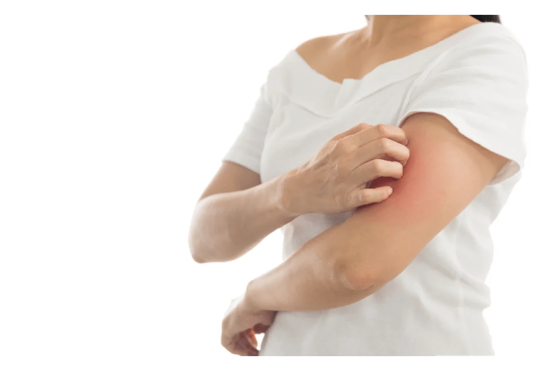 La psoriasi: cos'&egrave;, cause e trattamento