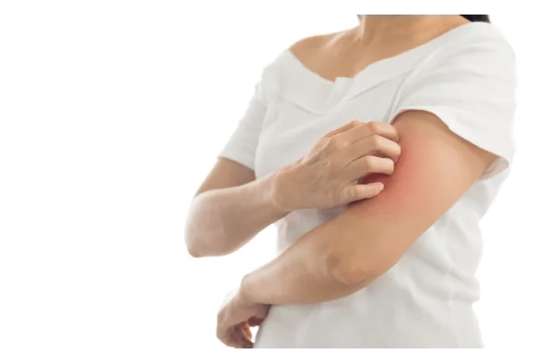 La psoriasi: cos'&egrave;, cause e trattamento