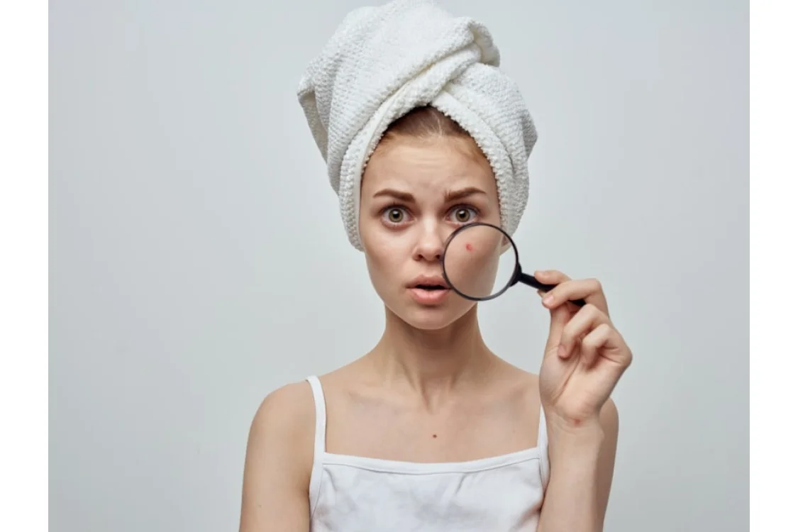 Iperpigmentazione cutanea: cause, rimedi e trattamenti