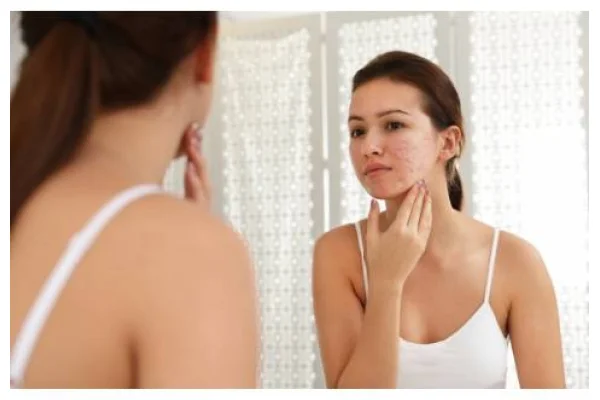 Come trattare le cicatrici da acne