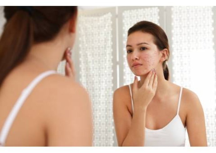 Come trattare le cicatrici da acne Come trattare le cicatrici da acne