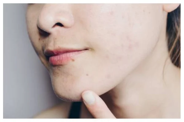 Come schiarire velocemente le macchie della pelle