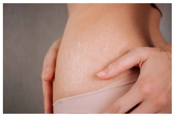 Guida al trattamento delle smagliature