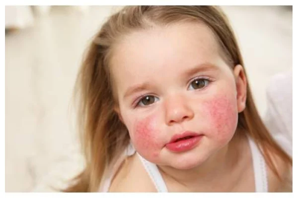 Quinta malattia: come evitarla, riconoscerla e curarla