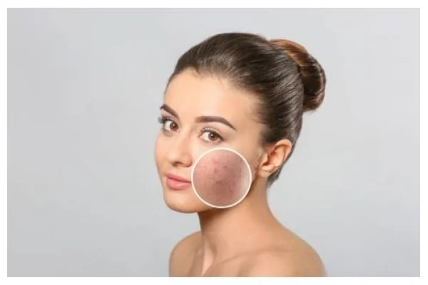 Secchezza cutanea: cause e rimedi