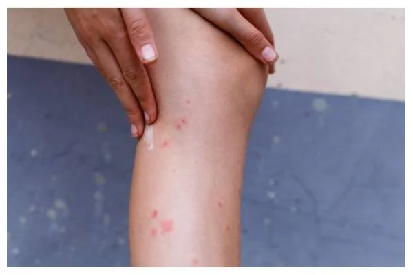 Follicolite: cos'è e come trattarla