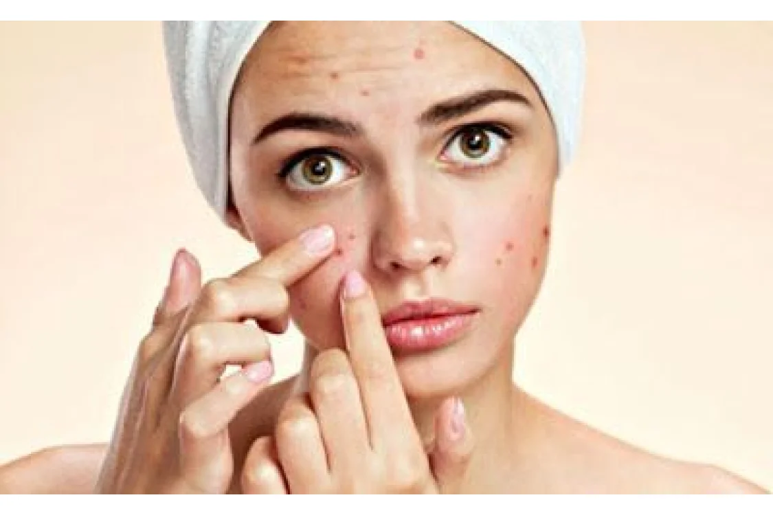 Viso con acne: ecco come detergerlo al meglio