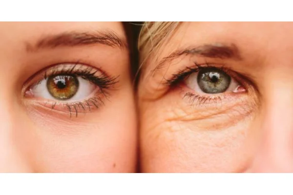 Occhiaie e borse sotto gli occhi: differenze e trattamenti