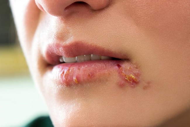 Herpes labialis