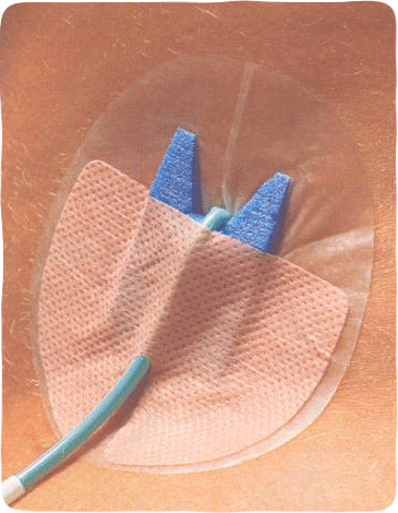 Drain - Guard Fissaggio per Cateteri Pericutanei