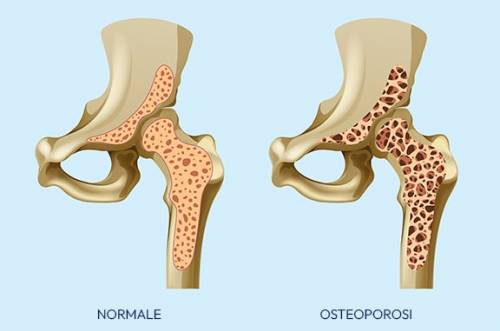 foto Osteoporosi