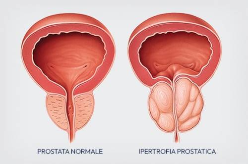 foto Ipertrofia prostatica